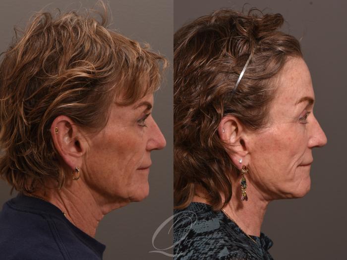 Facelift Case 1001983 Before & After Right Side | Serving Rochester, Syracuse & Buffalo, NY | Quatela Center for Plastic Surgery