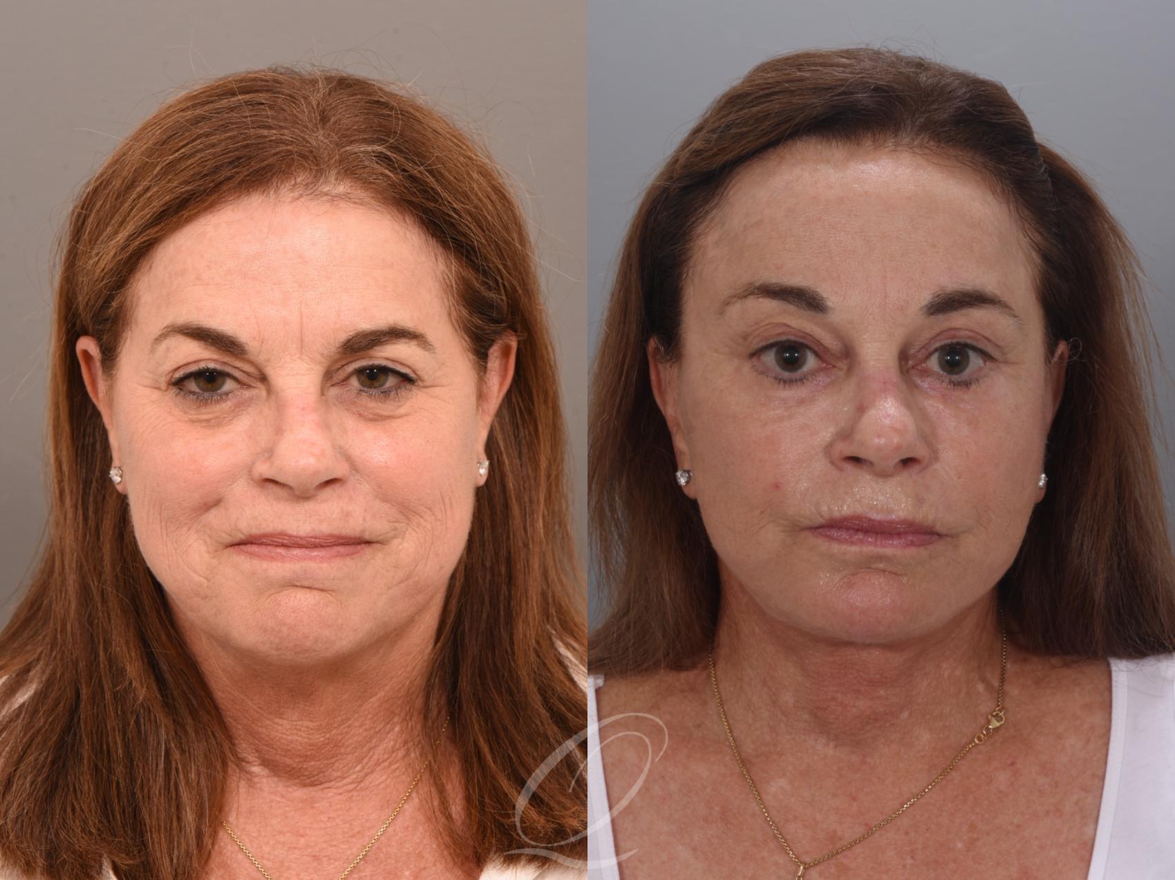 Facelift Case 1001986 Before & After Front | Serving Rochester, Syracuse & Buffalo, NY | Quatela Center for Plastic Surgery