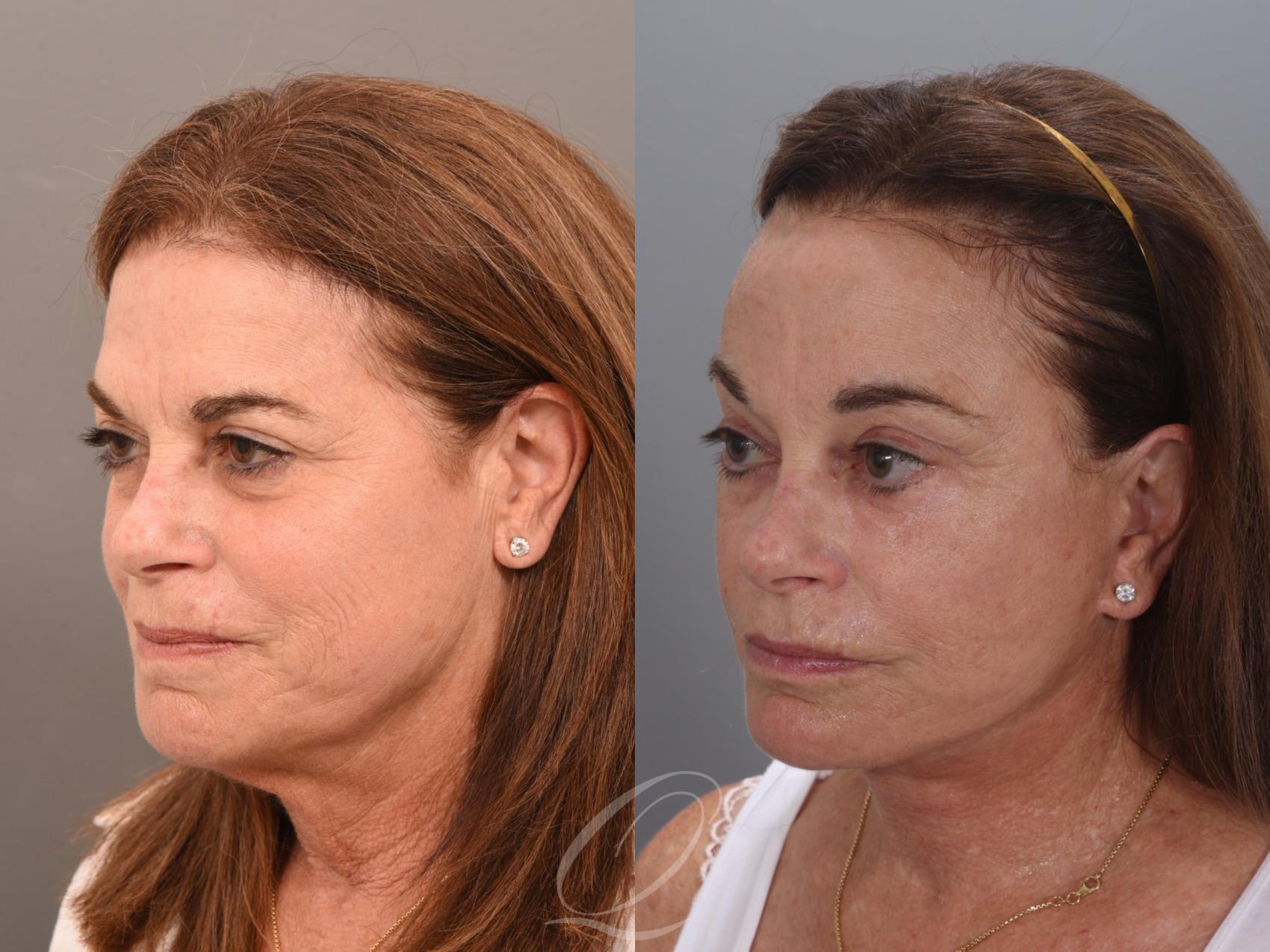 Facelift Case 1001986 Before & After Left Oblique | Serving Rochester, Syracuse & Buffalo, NY | Quatela Center for Plastic Surgery