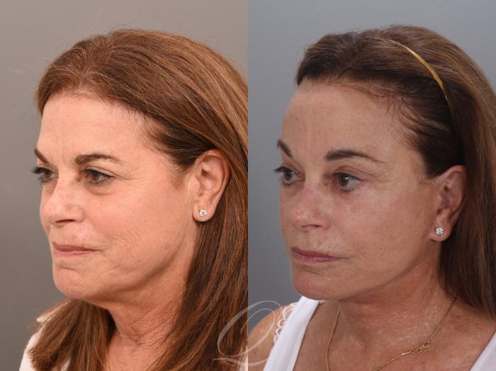Facelift Case 1001986 Before & After Left Oblique | Serving Rochester, Syracuse & Buffalo, NY | Quatela Center for Plastic Surgery