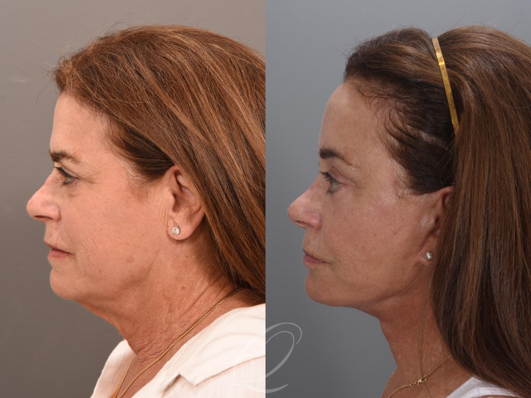 Facelift Case 1001986 Before & After Left Side | Serving Rochester, Syracuse & Buffalo, NY | Quatela Center for Plastic Surgery