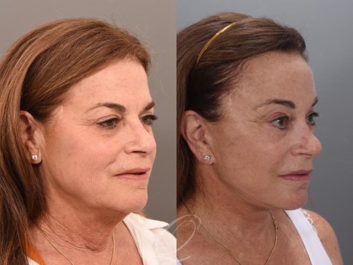 Facelift Case 1001986 Before & After Right Oblique | Serving Rochester, Syracuse & Buffalo, NY | Quatela Center for Plastic Surgery