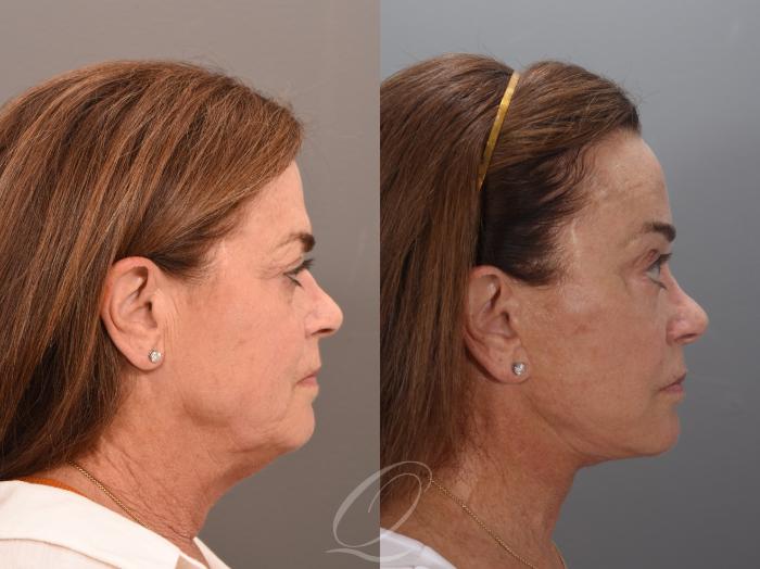 Facelift Case 1001986 Before & After Right Side | Serving Rochester, Syracuse & Buffalo, NY | Quatela Center for Plastic Surgery