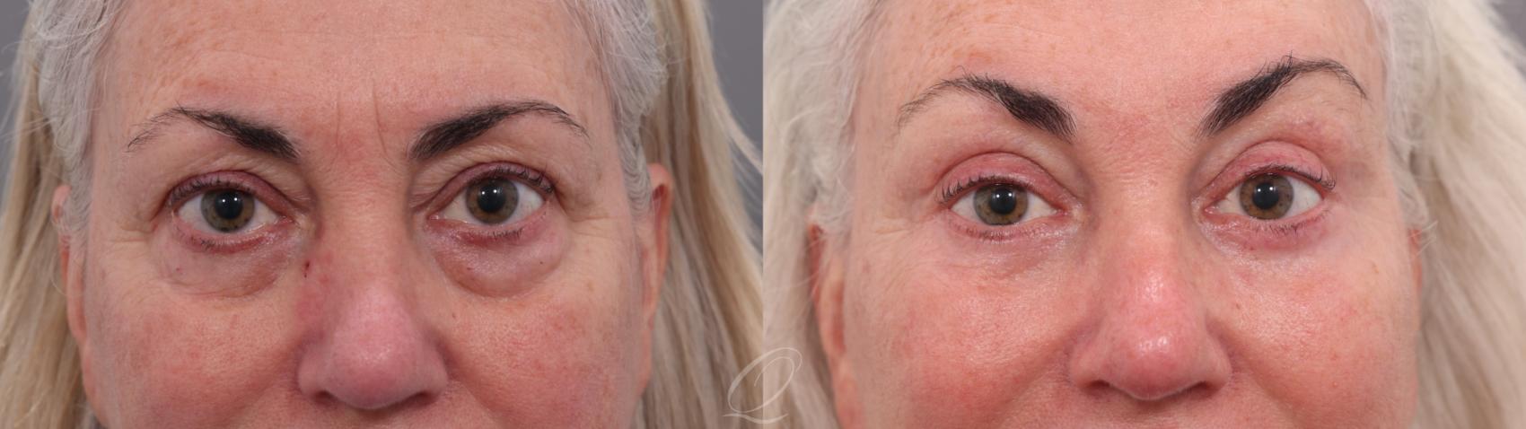 Facelift Case 1002003 Before & After Back | Serving Rochester, Syracuse & Buffalo, NY | Quatela Center for Plastic Surgery