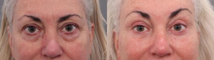 Facelift Case 1002003 Before & After Back | Serving Rochester, Syracuse & Buffalo, NY | Quatela Center for Plastic Surgery