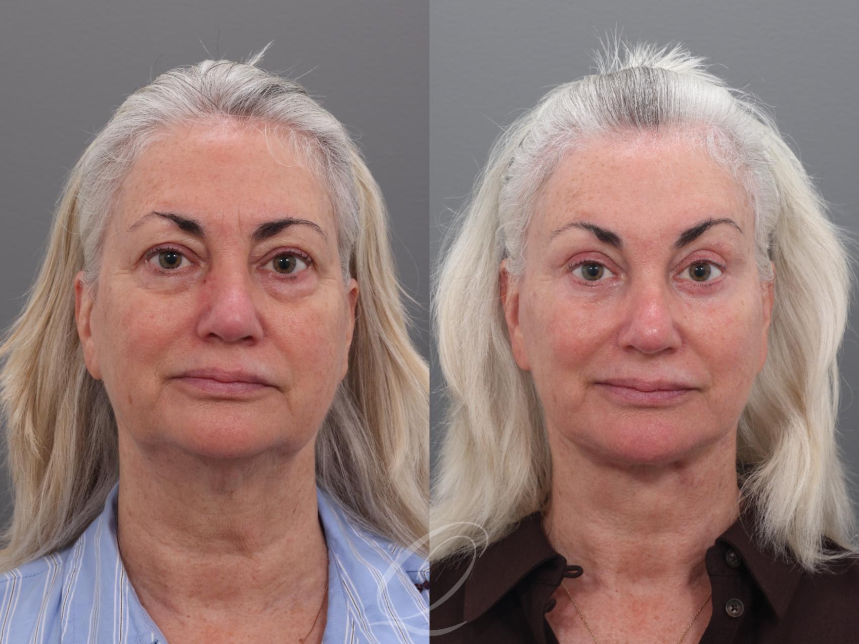 Facelift Case 1002003 Before & After Front | Serving Rochester, Syracuse & Buffalo, NY | Quatela Center for Plastic Surgery