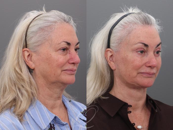 Facelift Case 1002003 Before & After Left Oblique | Serving Rochester, Syracuse & Buffalo, NY | Quatela Center for Plastic Surgery