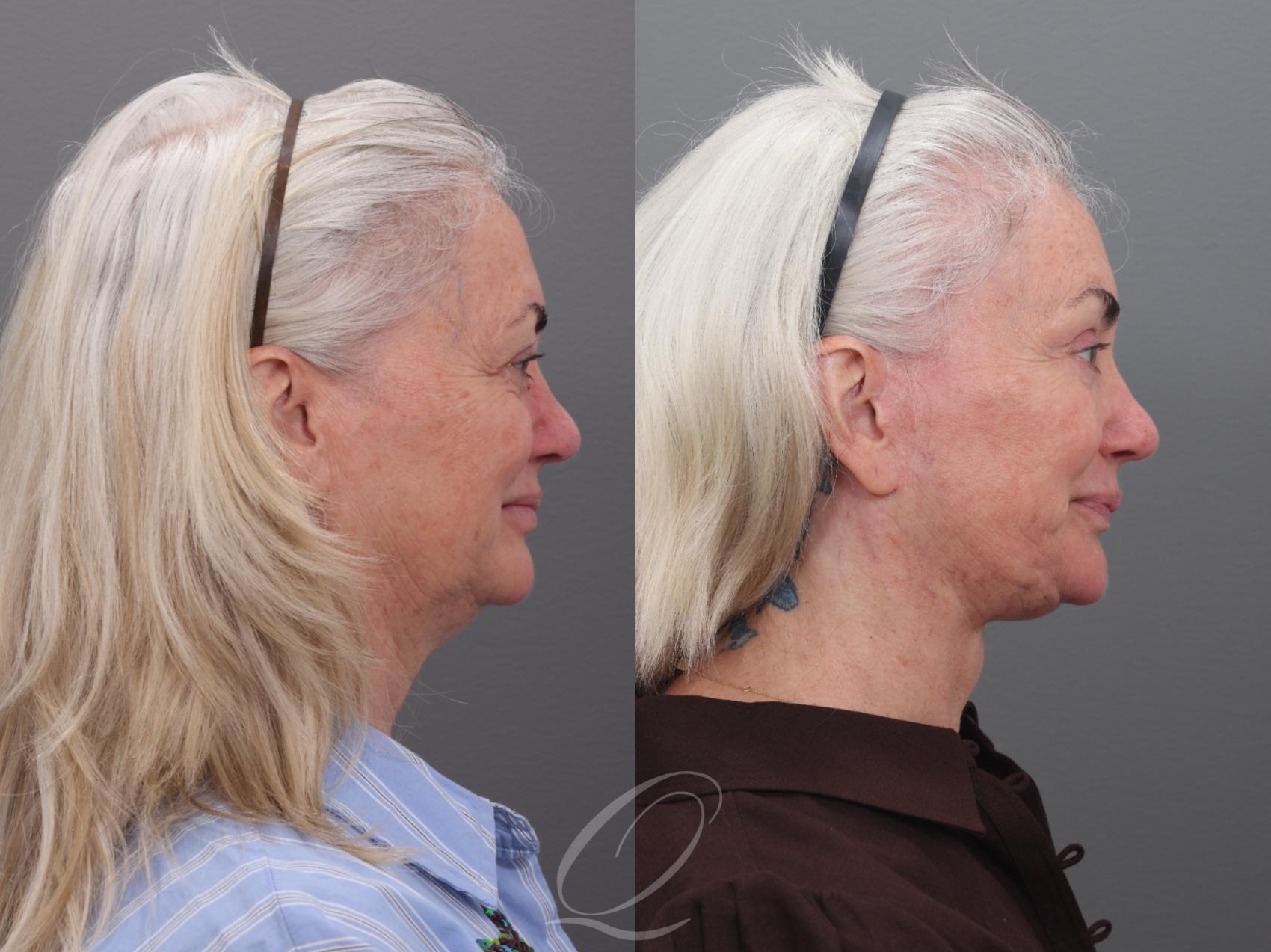 Facelift Case 1002003 Before & After Left Side | Serving Rochester, Syracuse & Buffalo, NY | Quatela Center for Plastic Surgery