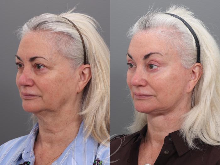 Facelift Case 1002003 Before & After Right Oblique | Serving Rochester, Syracuse & Buffalo, NY | Quatela Center for Plastic Surgery