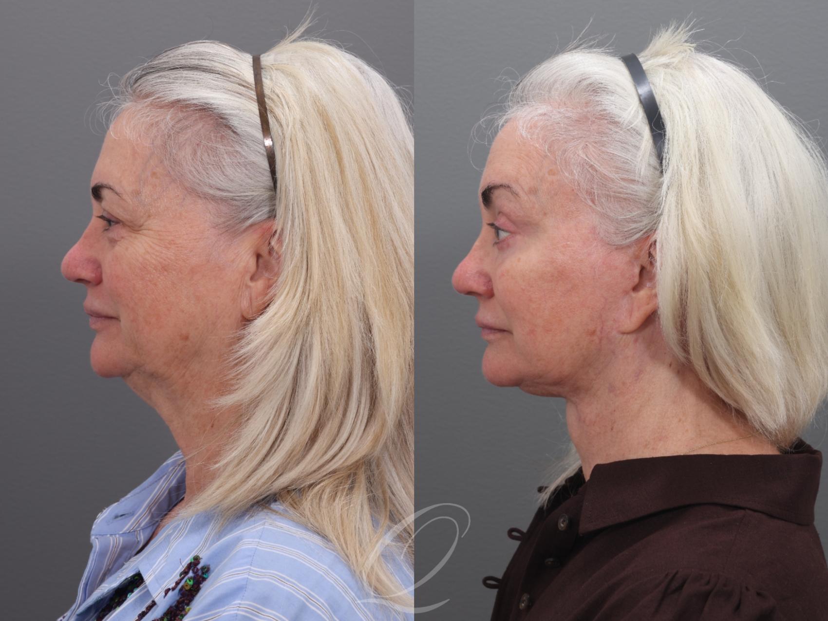 Facelift Case 1002003 Before & After Right Side | Serving Rochester, Syracuse & Buffalo, NY | Quatela Center for Plastic Surgery