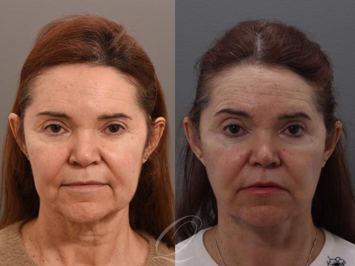 Facelift Case 1002006 Before & After Front | Serving Rochester, Syracuse & Buffalo, NY | Quatela Center for Plastic Surgery