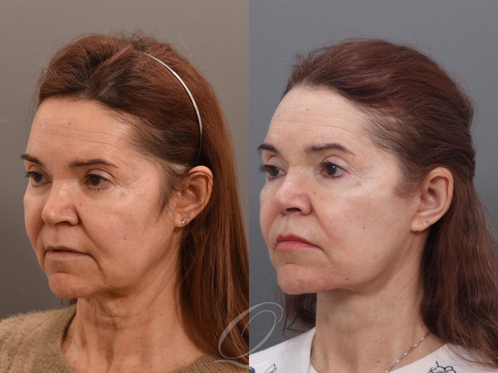 Facelift Case 1002006 Before & After Left Oblique | Serving Rochester, Syracuse & Buffalo, NY | Quatela Center for Plastic Surgery