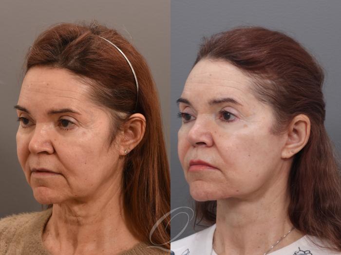 Facelift Case 1002006 Before & After Left Oblique | Serving Rochester, Syracuse & Buffalo, NY | Quatela Center for Plastic Surgery