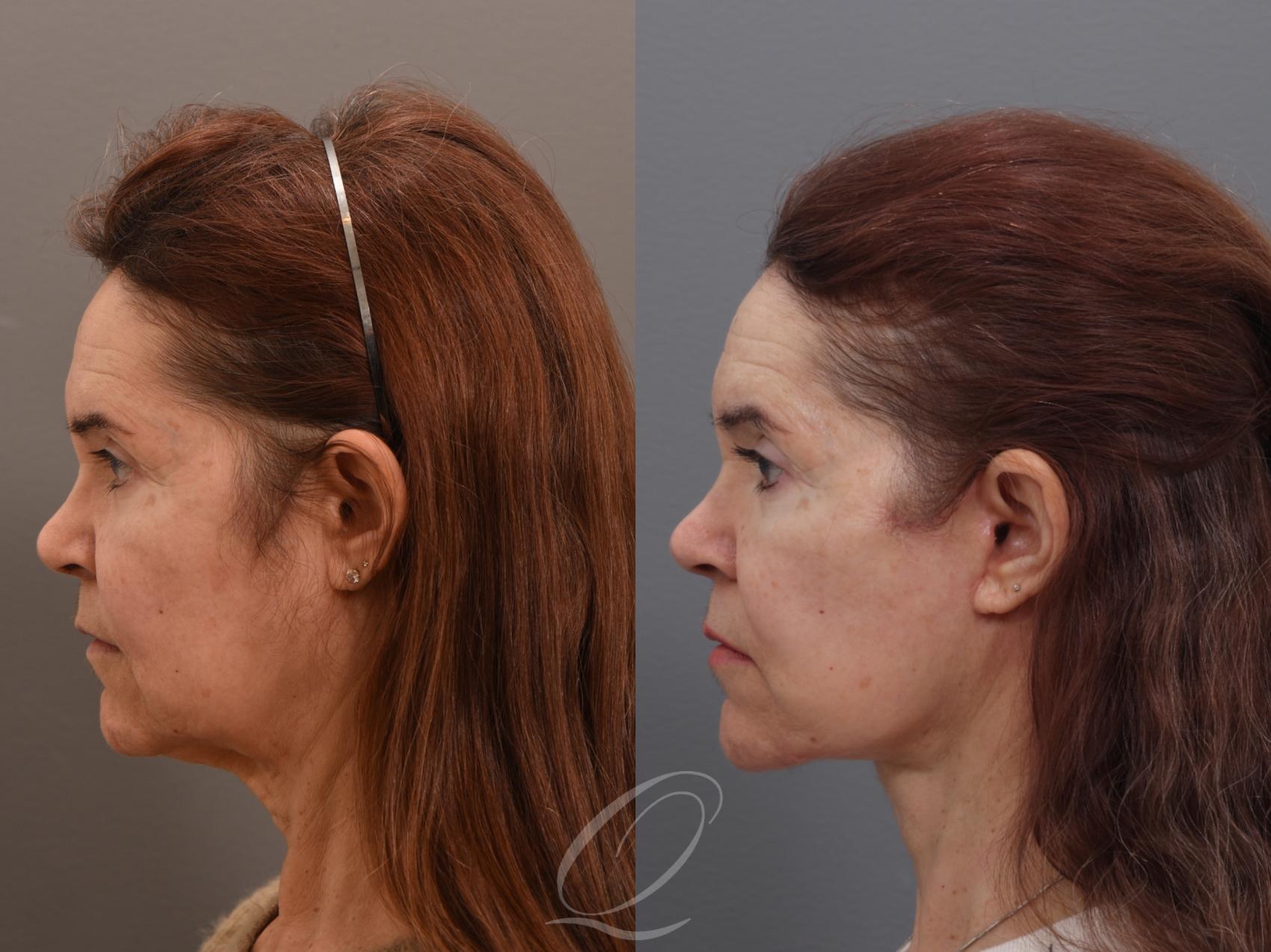 Facelift Case 1002006 Before & After Left Side | Serving Rochester, Syracuse & Buffalo, NY | Quatela Center for Plastic Surgery