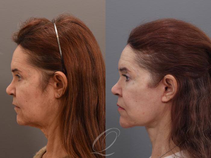 Facelift Case 1002006 Before & After Left Side | Serving Rochester, Syracuse & Buffalo, NY | Quatela Center for Plastic Surgery