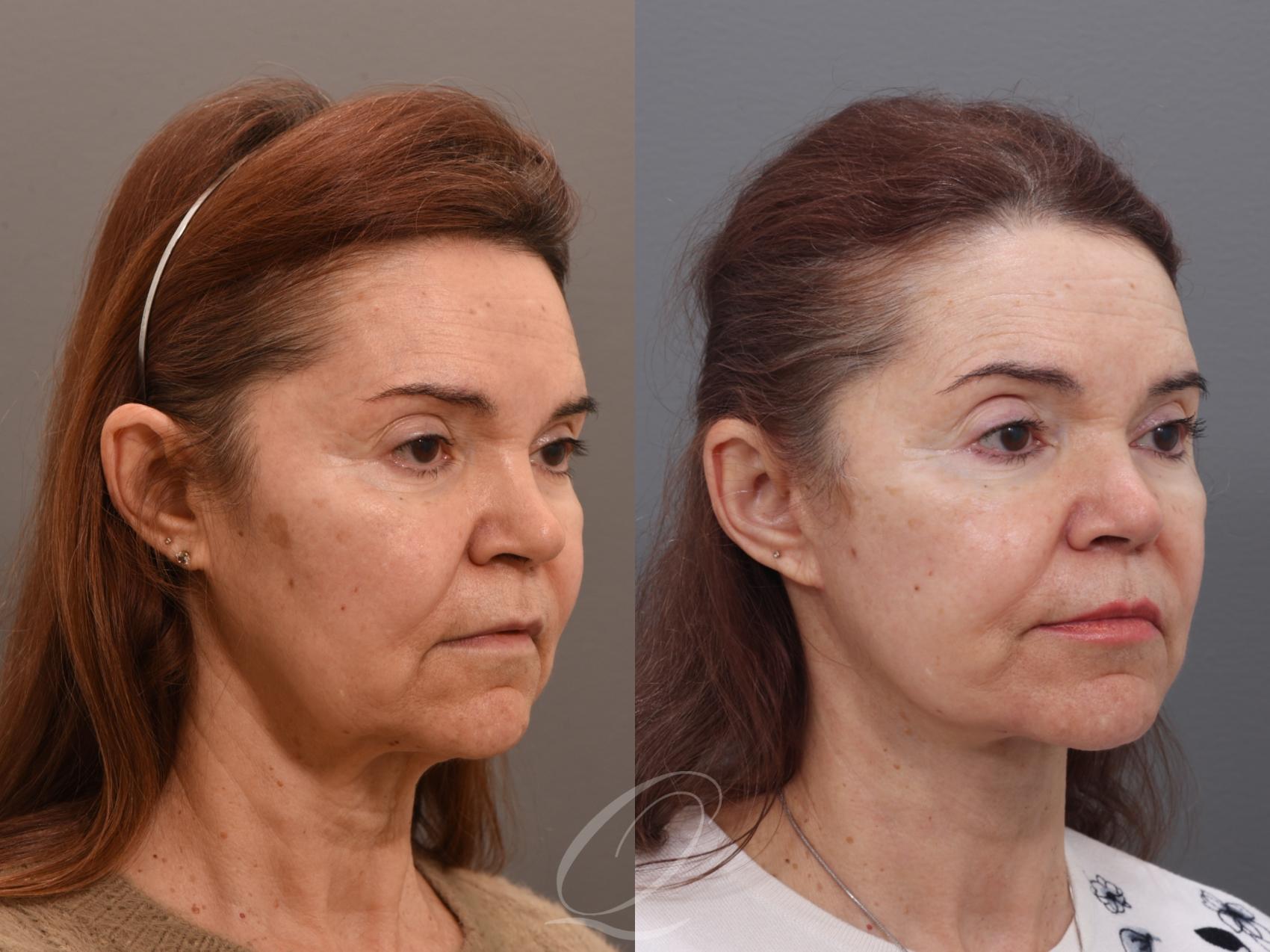 Facelift Case 1002006 Before & After Right Oblique | Serving Rochester, Syracuse & Buffalo, NY | Quatela Center for Plastic Surgery