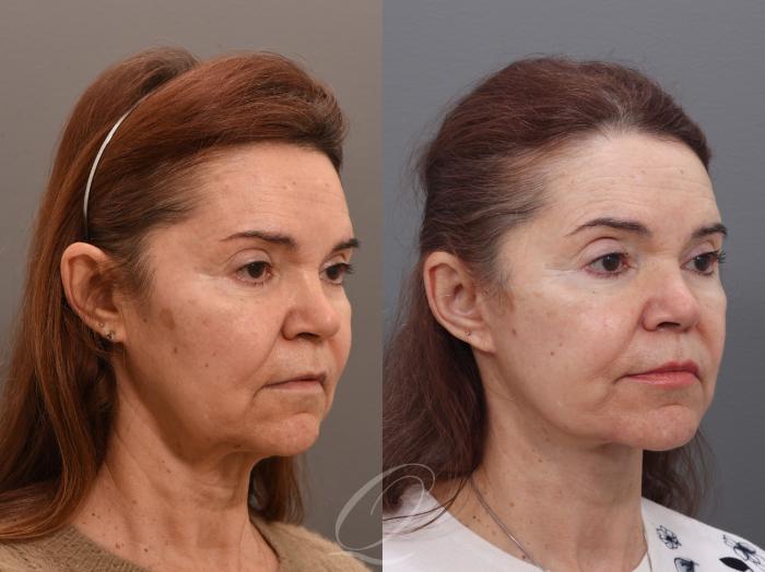 Facelift Case 1002006 Before & After Right Oblique | Serving Rochester, Syracuse & Buffalo, NY | Quatela Center for Plastic Surgery