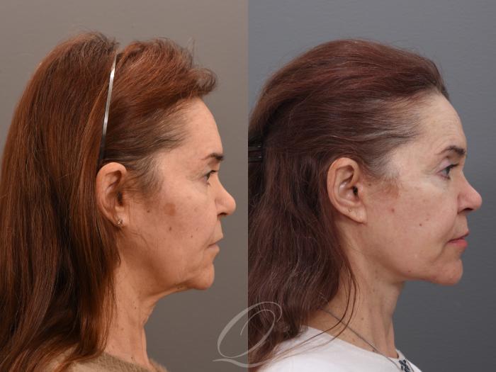 Facelift Case 1002006 Before & After Right Side | Serving Rochester, Syracuse & Buffalo, NY | Quatela Center for Plastic Surgery