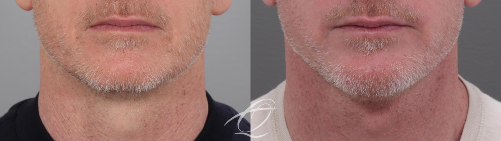 Facelift Case 1002010 Before & After Front | Serving Rochester, Syracuse & Buffalo, NY | Quatela Center for Plastic Surgery