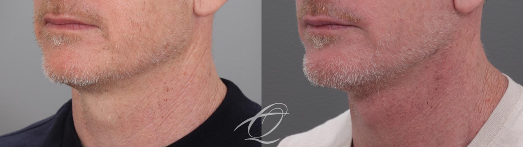 Facelift Case 1002010 Before & After Left Oblique | Serving Rochester, Syracuse & Buffalo, NY | Quatela Center for Plastic Surgery