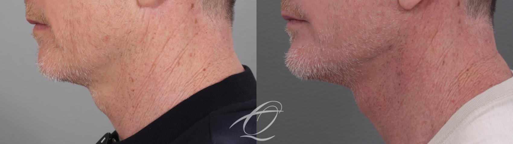 Facelift Case 1002010 Before & After Left Side | Serving Rochester, Syracuse & Buffalo, NY | Quatela Center for Plastic Surgery