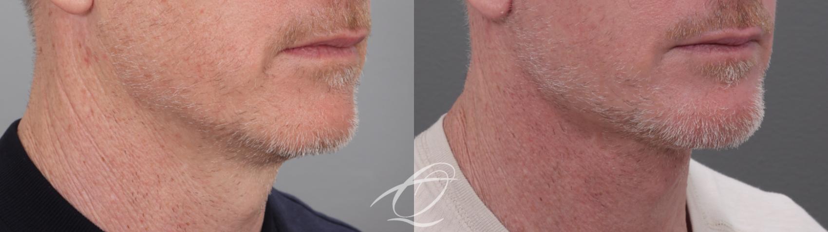 Facelift Case 1002010 Before & After Right Oblique | Serving Rochester, Syracuse & Buffalo, NY | Quatela Center for Plastic Surgery