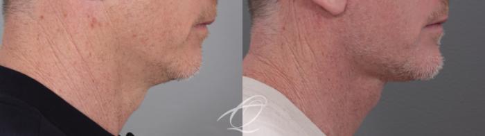 Facelift Case 1002010 Before & After Right Side | Serving Rochester, Syracuse & Buffalo, NY | Quatela Center for Plastic Surgery