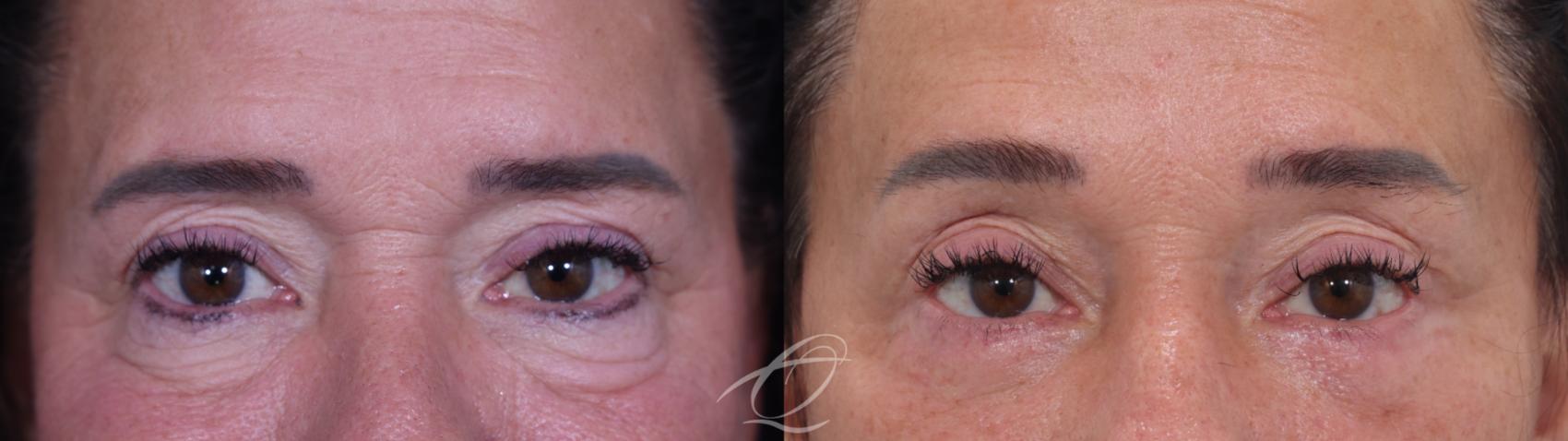 Facelift Case 1002019 Before & After Blepharoplasty | Serving Rochester, Syracuse & Buffalo, NY | Quatela Center for Plastic Surgery