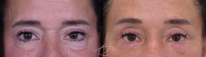 Facelift Case 1002019 Before & After Blepharoplasty | Serving Rochester, Syracuse & Buffalo, NY | Quatela Center for Plastic Surgery