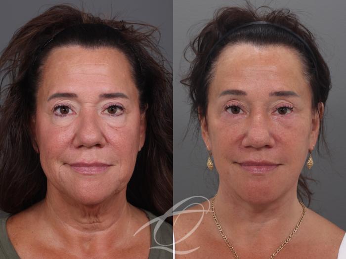 Facelift Case 1002019 Before & After Front | Serving Rochester, Syracuse & Buffalo, NY | Quatela Center for Plastic Surgery