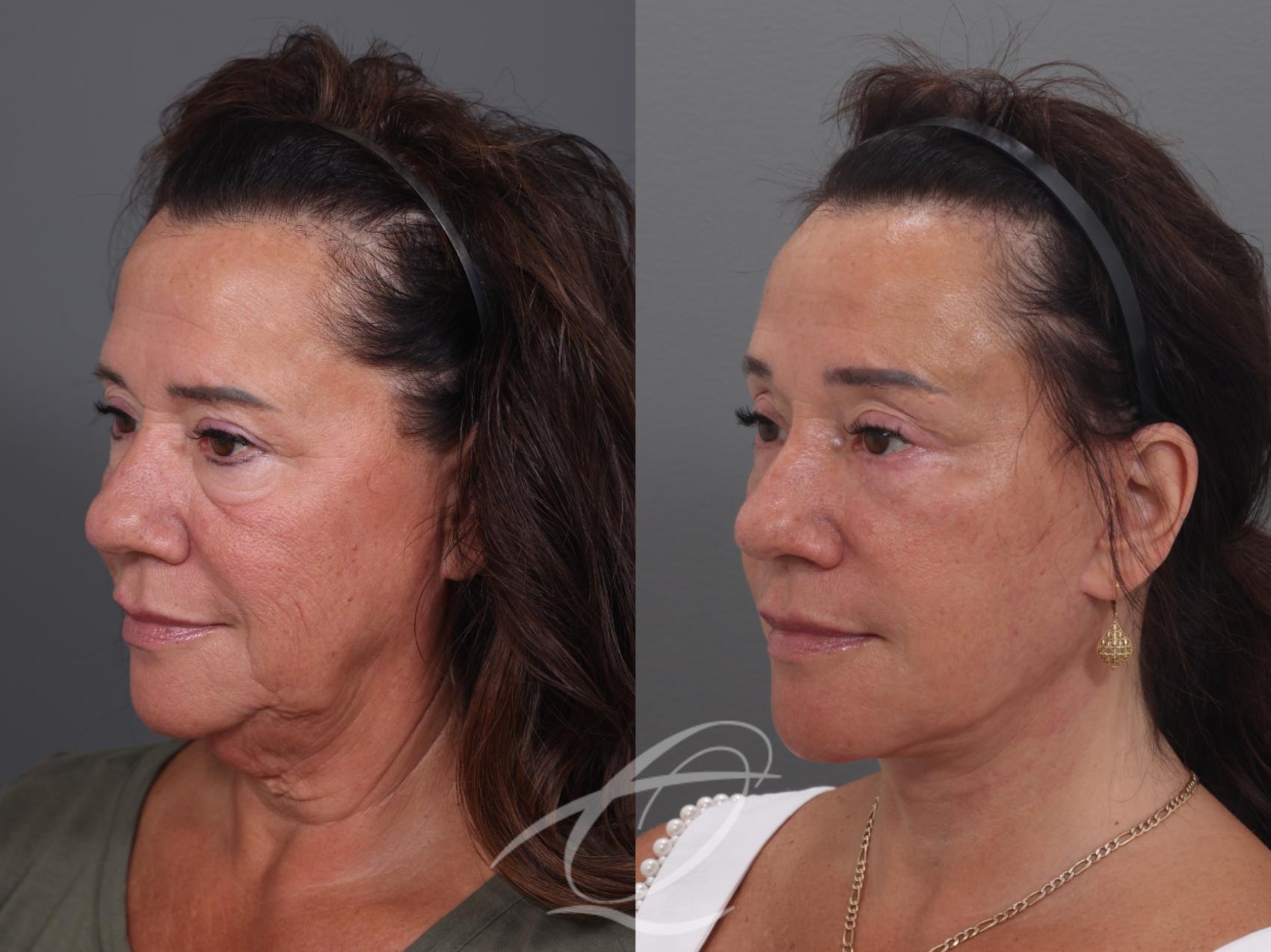 Facelift Case 1002019 Before & After Left Oblique | Serving Rochester, Syracuse & Buffalo, NY | Quatela Center for Plastic Surgery