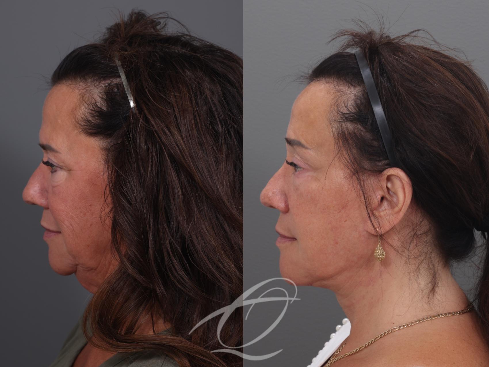 Facelift Case 1002019 Before & After Left Side | Serving Rochester, Syracuse & Buffalo, NY | Quatela Center for Plastic Surgery