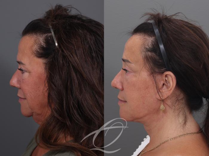 Facelift Case 1002019 Before & After Left Side | Serving Rochester, Syracuse & Buffalo, NY | Quatela Center for Plastic Surgery