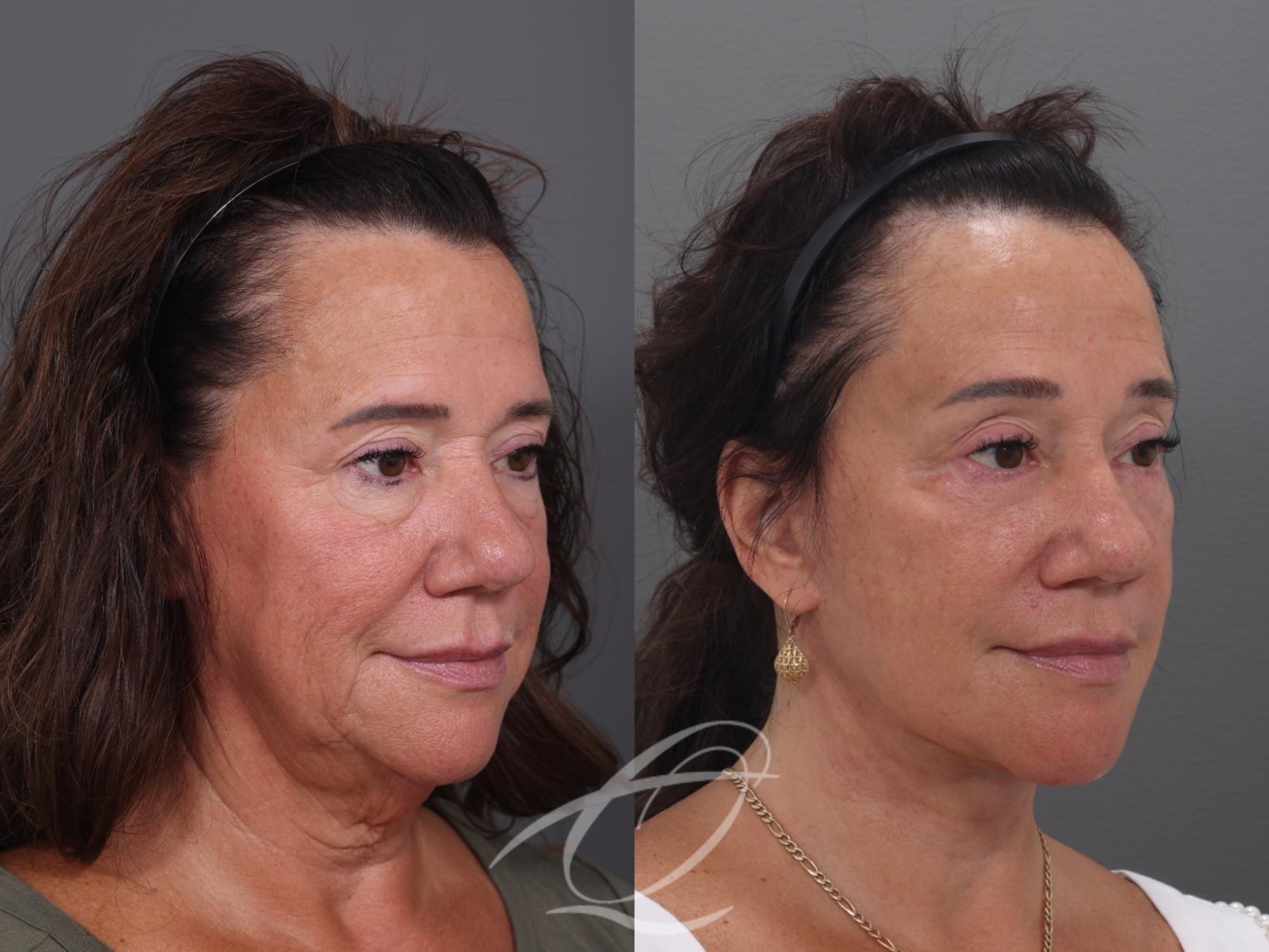 Facelift Case 1002019 Before & After Right Oblique | Serving Rochester, Syracuse & Buffalo, NY | Quatela Center for Plastic Surgery