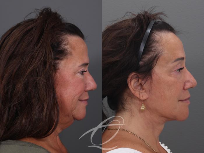Facelift Case 1002019 Before & After Right Side | Serving Rochester, Syracuse & Buffalo, NY | Quatela Center for Plastic Surgery