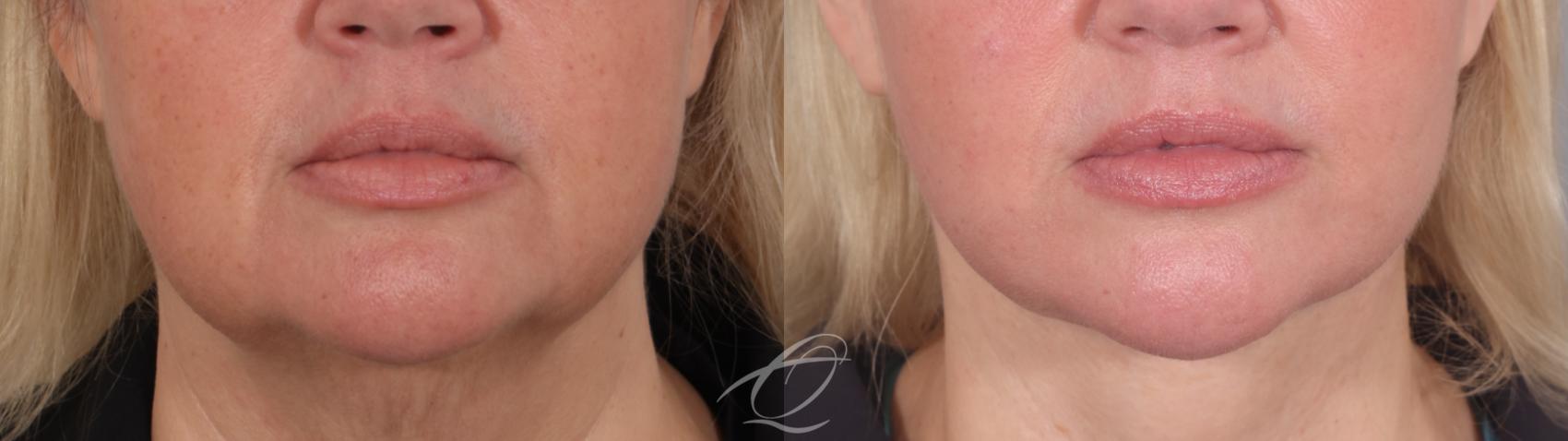Facelift Case 1002020 Before & After Front | Serving Rochester, Syracuse & Buffalo, NY | Quatela Center for Plastic Surgery