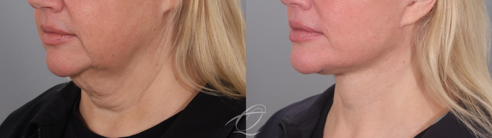 Facelift Case 1002020 Before & After Left Oblique | Serving Rochester, Syracuse & Buffalo, NY | Quatela Center for Plastic Surgery