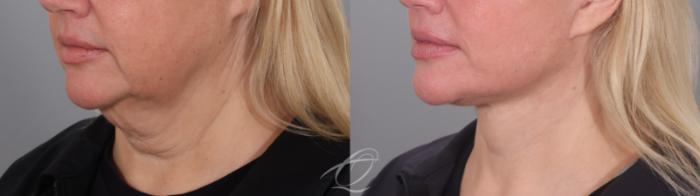 Facelift Case 1002020 Before & After Left Oblique | Serving Rochester, Syracuse & Buffalo, NY | Quatela Center for Plastic Surgery