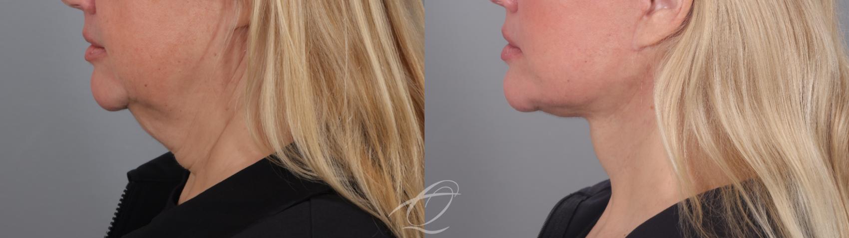 Facelift Case 1002020 Before & After Left Side | Serving Rochester, Syracuse & Buffalo, NY | Quatela Center for Plastic Surgery