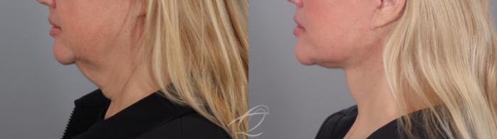 Facelift Case 1002020 Before & After Left Side | Serving Rochester, Syracuse & Buffalo, NY | Quatela Center for Plastic Surgery