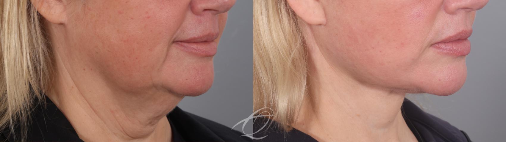Facelift Case 1002020 Before & After Right Oblique | Serving Rochester, Syracuse & Buffalo, NY | Quatela Center for Plastic Surgery