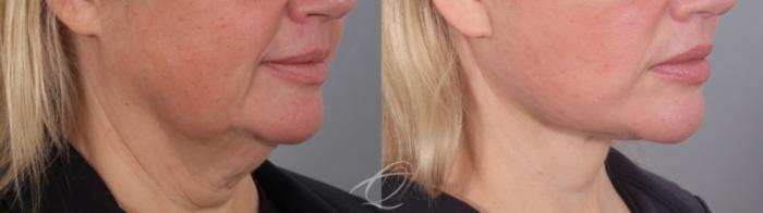 Facelift Case 1002020 Before & After Right Oblique | Serving Rochester, Syracuse & Buffalo, NY | Quatela Center for Plastic Surgery