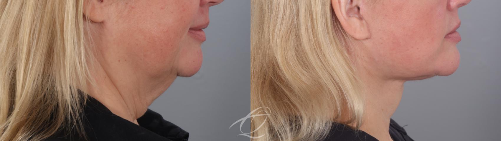 Facelift Case 1002020 Before & After Right Side | Serving Rochester, Syracuse & Buffalo, NY | Quatela Center for Plastic Surgery