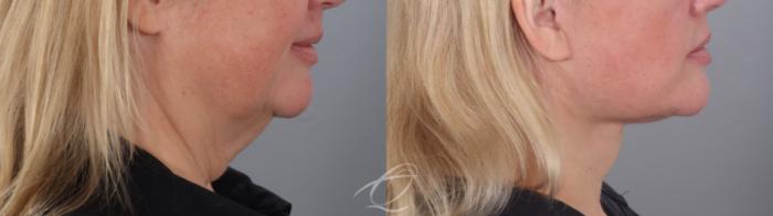 Facelift Case 1002020 Before & After Right Side | Serving Rochester, Syracuse & Buffalo, NY | Quatela Center for Plastic Surgery