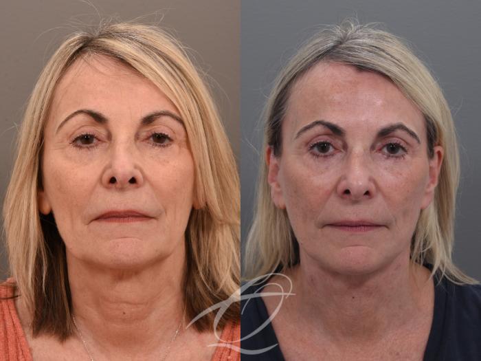 Facelift Case 1002022 Before & After Front | Serving Rochester, Syracuse & Buffalo, NY | Quatela Center for Plastic Surgery