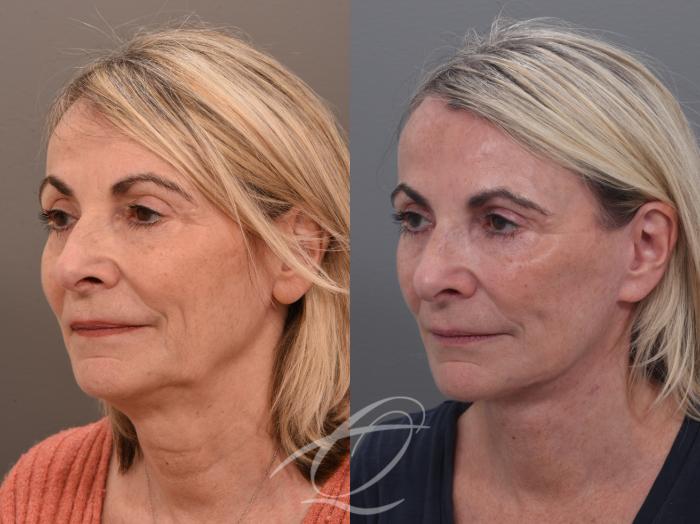 Facelift Case 1002022 Before & After Left Oblique | Serving Rochester, Syracuse & Buffalo, NY | Quatela Center for Plastic Surgery