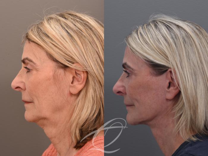 Facelift Case 1002022 Before & After Left Side | Serving Rochester, Syracuse & Buffalo, NY | Quatela Center for Plastic Surgery