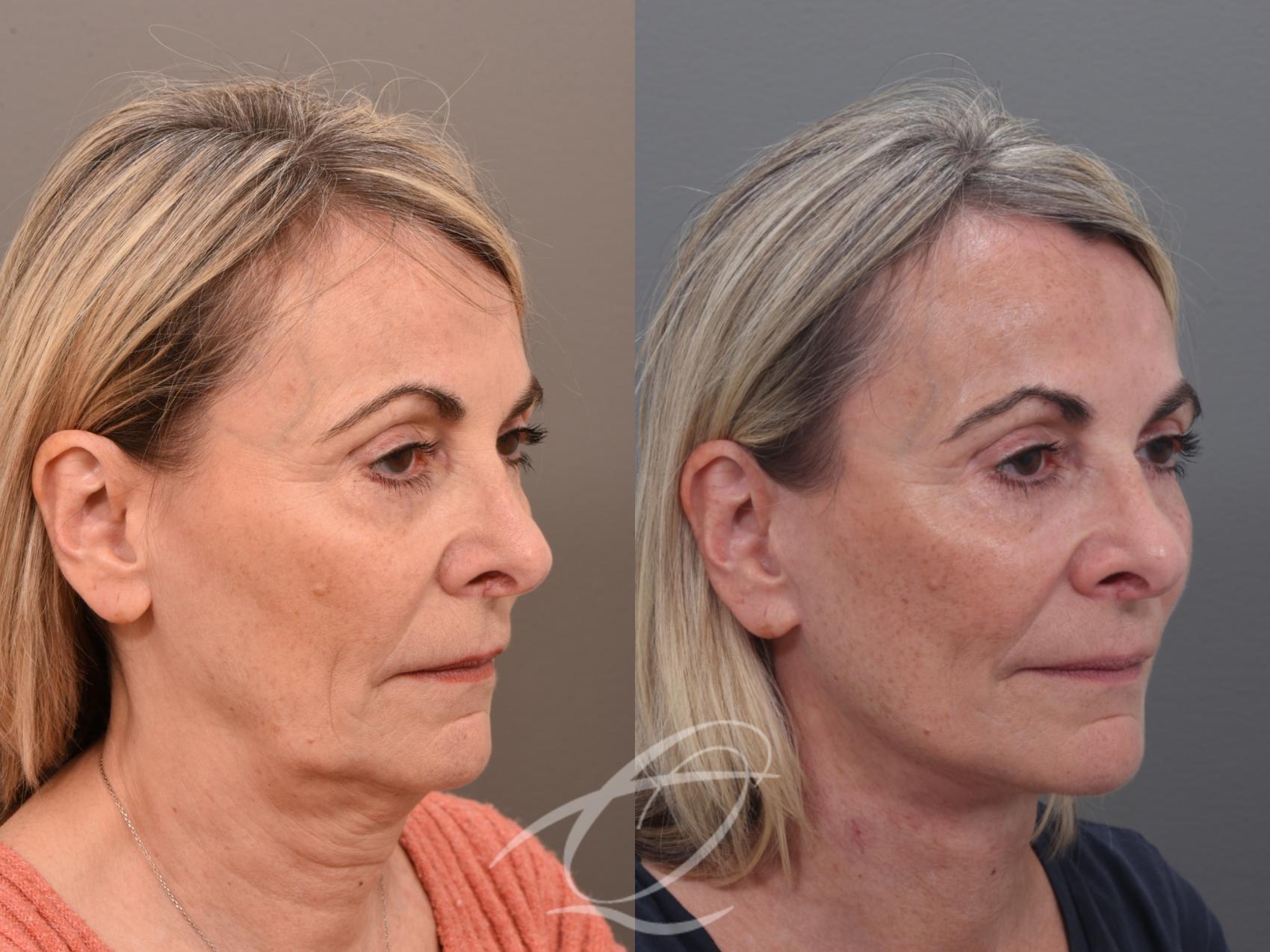 Facelift Case 1002022 Before & After Right Oblique | Serving Rochester, Syracuse & Buffalo, NY | Quatela Center for Plastic Surgery