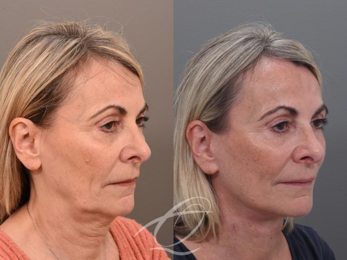 Facelift Case 1002022 Before & After Right Oblique | Serving Rochester, Syracuse & Buffalo, NY | Quatela Center for Plastic Surgery