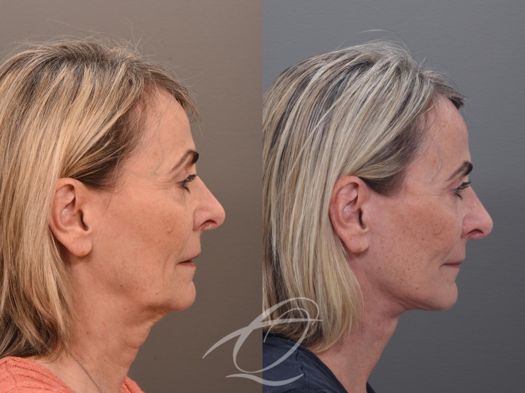 Facelift Case 1002022 Before & After Right Side | Serving Rochester, Syracuse & Buffalo, NY | Quatela Center for Plastic Surgery